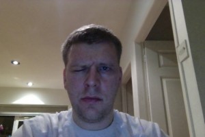 Day 6 - Frowning Attempt Day 6 Bells Palsy Pictures Frowning Face