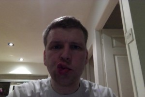 Day 6 Bells Palsy Pictures Trying to blow a kiss