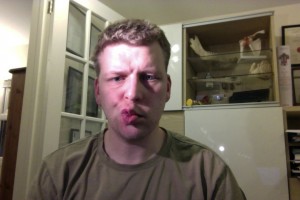 Day 15 Blow Kiss bells palsy pictures day 15 blow kiss