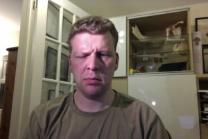 Frown Day 15 bells palsy Day 15 frown