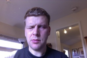 Day 9 Eye Closing Attempt Bells Palsy Day 9 Eye Closing Attempt