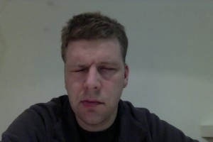 Bells Palsy eyes shut day 20