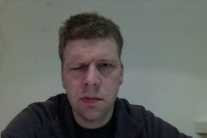 Bells Palsy frowning day 20